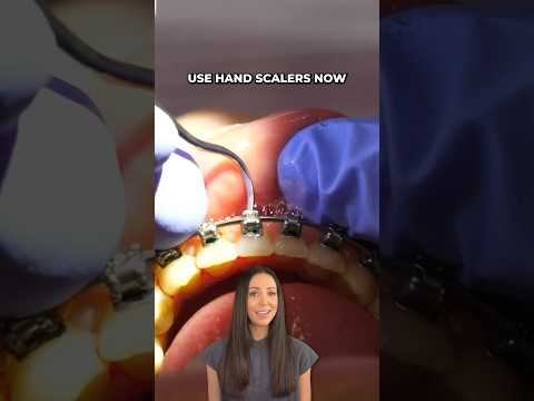 braces teeth cleaning at dentist #shorts