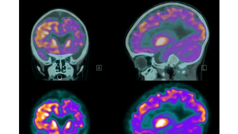 3 Warning Signs of Memory Loss That Most People Overlook