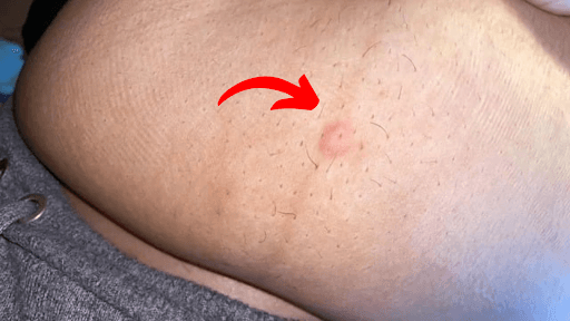 Most Solutions for Bloating Overlook This Underlying Gut Problem